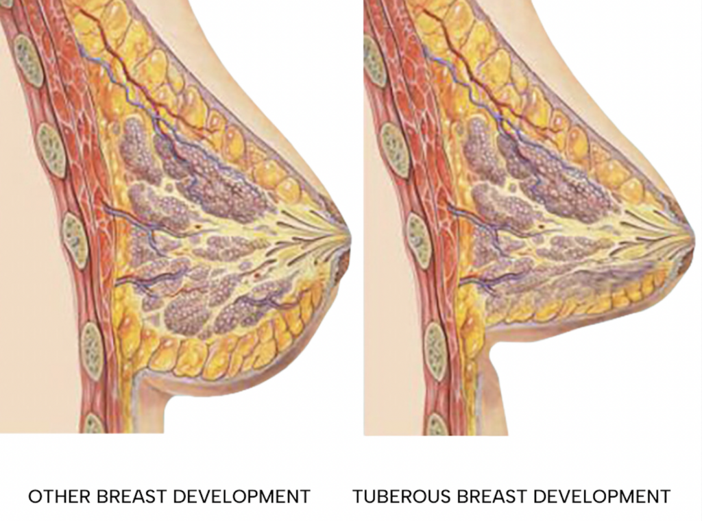 Understanding PDO Breast Lift A Comprehensive Guide